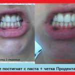 резултат продентал