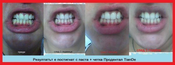 резултат продентал